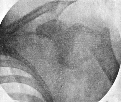 Fig. 25.—Dislocation of Shoulder with Fracture of Neck
of Humerus.