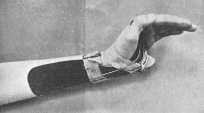 Fig. 31.—“Cock-up” Splint, for maintaining
Dorsiflexion at Wrist.