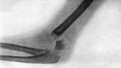 Fig. 33.—Radiogram of Supra-condylar Fracture of
Humerus, in a child æt. 7.