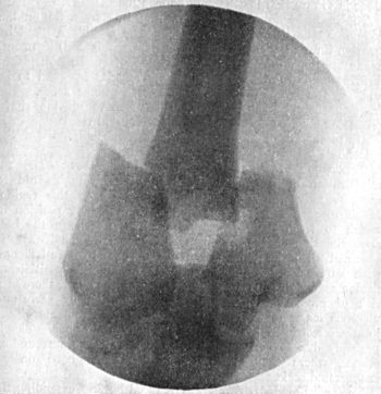 Fig. 34.—Radiogram of T-shaped Fracture of Lower End
of Humerus.