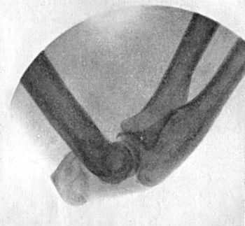Fig. 35.—Radiogram of Fracture of Olecranon Process,
showing marked degree of displacement.