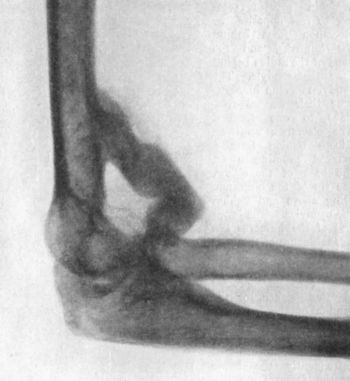 Fig. 37.—Bony Outgrowth in relation to insertion of
Brachialis Muscle, following Backward Dislocation of Elbow.