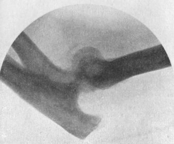 Fig. 38.—Radiogram of Incomplete Backward Dislocation
of Elbow.