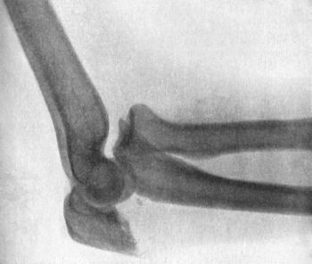 Fig. 39.—Forward Dislocation of Elbow, with Fracture
of Olecranon.