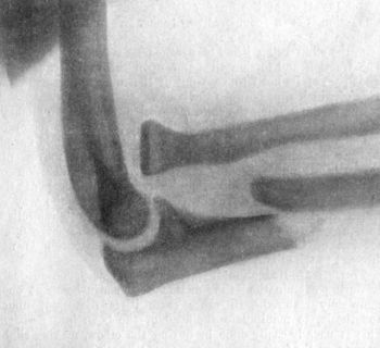 Fig. 40.—Radiogram of Forward Dislocation of Head of
Radius, with Fracture of Shaft of Ulna.