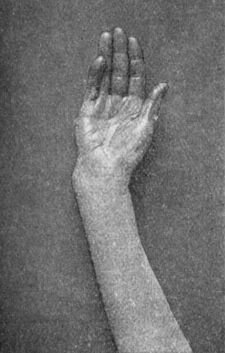 Fig. 43.—Colles' Fracture showing radial deviation of
hand.