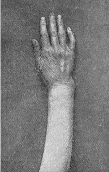 Fig. 44.—Colles' Fracture showing undue prominence of
ulnar styloid.