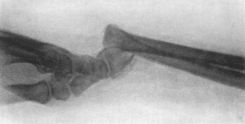 Fig. 47.—Radiogram of Smith's Fracture.