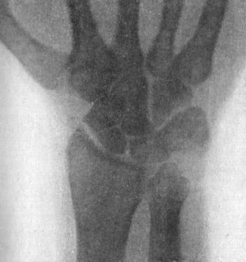 Fig. 49.—Radiogram showing Fracture of Navicular
(Scaphoid) Bone.