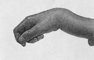 Fig. 50.—Dorsal Dislocation of Wrist at Radio-carpal
Articulation, in a man, æt. 24, from a fall.