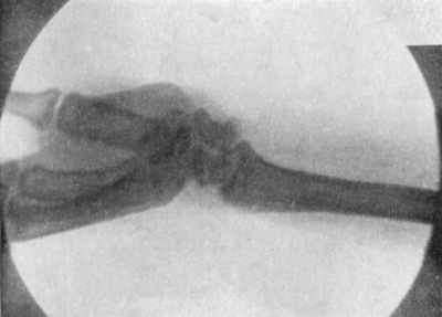 Fig. 51.—Radiogram showing Forward Dislocation of
Navicular (Scaphoid) Bone.