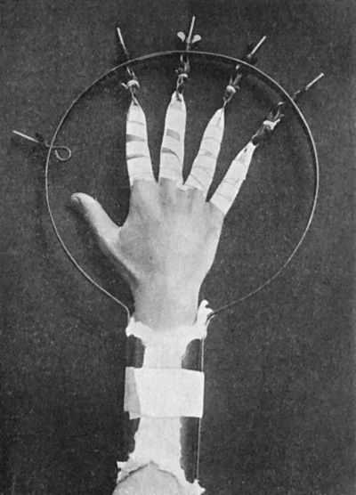 Fig. 52.—Extension apparatus for Oblique Fracture of
Metacarpals.