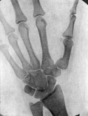 Fig. 53.—Radiogram of Bennett's Fracture of Base of
Metacarpal of Right Thumb.