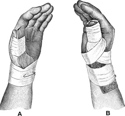 Fig. 54.—A. Splint applied as used by Bennett. B.
Poroplastic Moulded Splint for Bennett's Fracture.