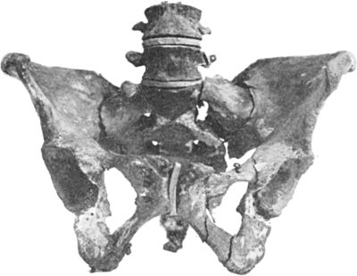 Fig. 55.—Multiple Fracture of Pelvis through
Horizontal and Descending Rami of both Pubes, and Longitudinal
Fracture of left side of Sacrum.