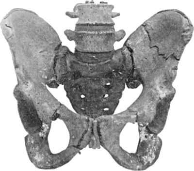 Fig. 56.—Fracture of left Iliac Bone; and of both
Pubic Arches.