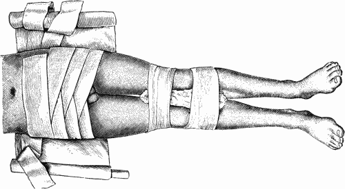 Fig. 57.—Many-tailed Bandage and Binder for Fracture
of Pelvic Girdle.