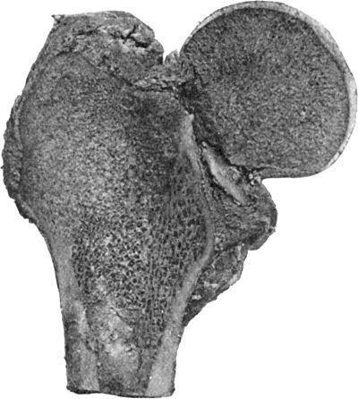 Fig. 61.—Fracture through Narrow Part of Neck of Femur
on section. The Neck of the bone has undergone absorption.