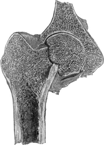 Fig. 62.—Impacted Fracture through Narrow Part of Neck
of Femur.