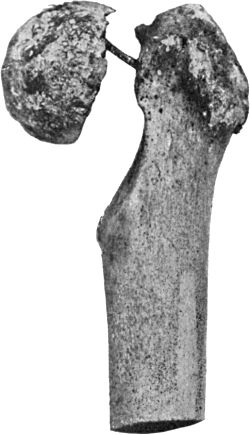 Fig. 64.—Fracture of Narrow Part of Neck of Femur. The
neck has become absorbed, the head has not united, and a false joint
has formed.