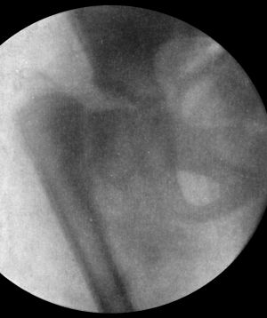 Fig. 65.—Coxa Vara following Fracture of Neck of Femur
in a child.