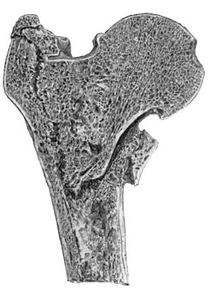 Fig. 67.—Fracture through Base of Neck of Femur with
Impaction into the Trochanters.