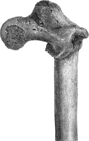 Fig. 69.—Fracture of the Femur just below the Small
Trochanter united, showing flexion and lateral rotation of upper
fragment.