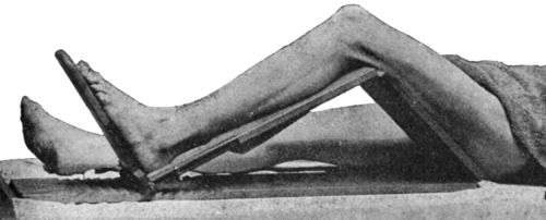 Fig. 70.—Adjustable Double-inclined Plane.