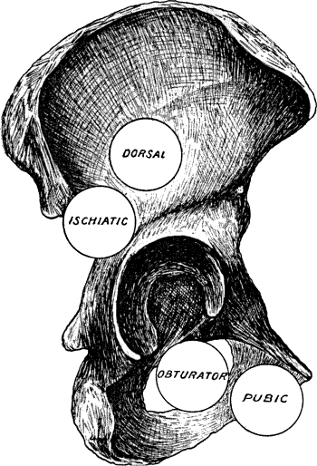 Fig. 71.—Diagram of the most common Dislocations of
the Hip.