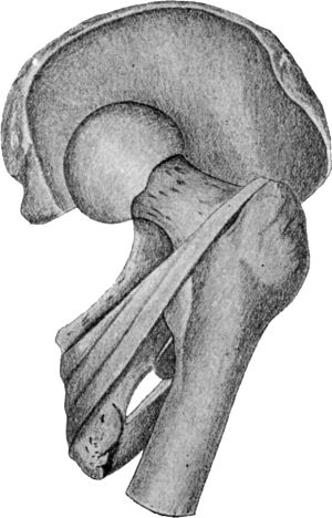Fig. 73.—Dislocation on to Dorsum Ilii. Note relation
of neck of femur to tendons of obturator internus and gemelli
(diagrammatic).