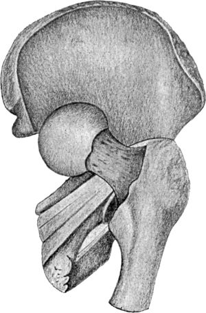 Fig. 74.—Dislocation into the vicinity of the
Ischiatic Notch. Note relation of neck of femur to tendons of
obturator and gemelli, “Dislocation below the tendon” (diagrammatic).