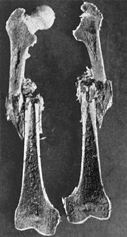 Fig. 75.—Longitudinal section of Femur showing recent
Fracture of Shaft with overriding of Fragments.