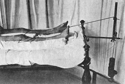 Fig. 76.—Radiogram of Steinmann's Apparatus applied
for Direct Extension to the Femur.