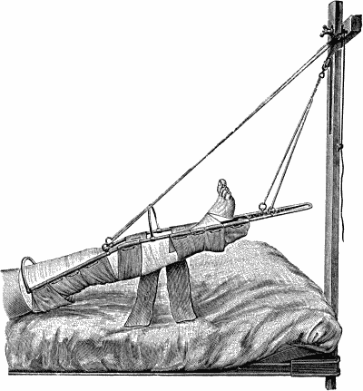 Fig. 77.—Hodgen's Splint.