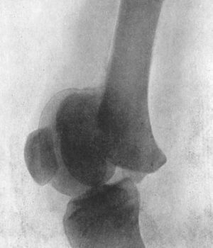 Fig. 82.—Radiogram of Separation of Lower Epiphysis of
Femur, with backward displacement of the diaphysis; pressure on
popliteal vessels caused sloughing of calf.