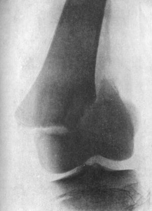 Fig. 83.—Separation of Lower Epiphysis of Femur, with
fracture of lower end of diaphysis.