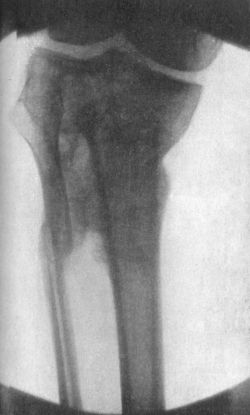 Fig. 84.—Radiogram of Fracture of Head of Tibia and
Upper Third of Fibula.