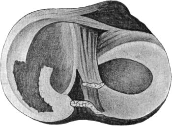 Fig. 86.—Diagram of Longitudinal Tear of Posterior End
of Right Medial Semilunar Meniscus.