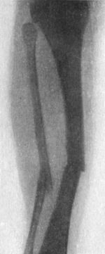 Fig. 89.—Radiogram of Transverse Fracture of both
Bones of Leg by direct violence.