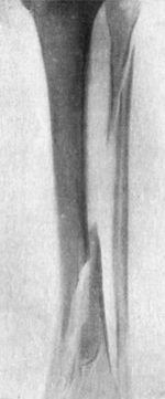 Fig. 90.—Radiogram of Oblique Fracture of both Bones
of Leg by indirect violence.