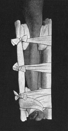 Fig. 92.—Box Splint (applied).