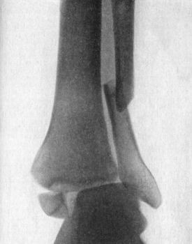 Fig. 94.—Radiogram of Pott's Fracture with lateral
displacement of foot.