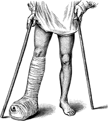 Fig. 95.—Ambulant Splint of plaster of Paris.