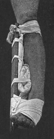 Fig. 96.—Dupuytren's Splint applied to correct
eversion of foot.