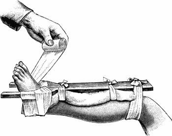 Fig. 97.—Syme's Horse-shoe Splint applied to correct
backward displacement of foot.