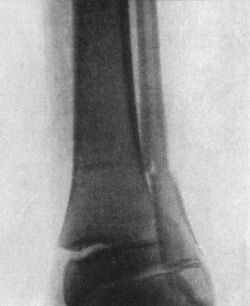 Fig. 98.—Radiogram of Fracture of lower end of Fibula,
with separation of lower epiphysis of Tibia.