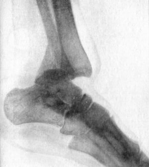 Fig. 99.—Radiogram of Backward Dislocation of Ankle.