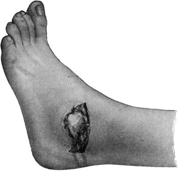 Fig. 100.—Compound Dislocation of the Talus.