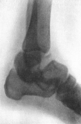 Fig. 101.—Radiogram of Fracture-Dislocation of Talus.