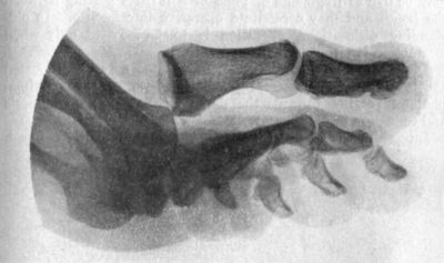 Fig. 102.—Radiogram of Dislocation of Toes.